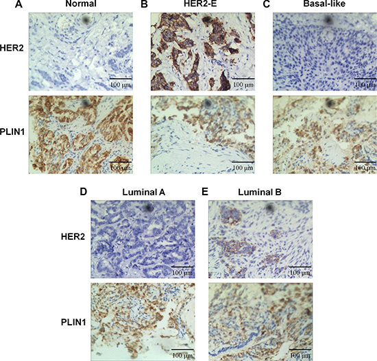 Expression of PLIN1 in breast cancer.