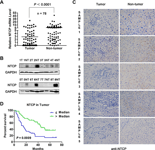 Expression of NTCP in HCC tumor tissues and its prognostic value for patient survival.