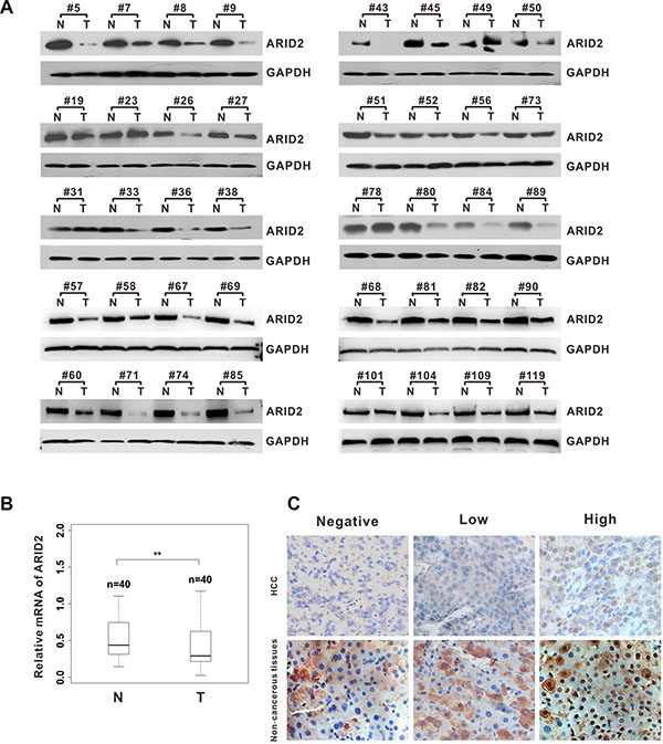 ARID2 expression is downregulated in human hepatocellular carcinoma tissues.