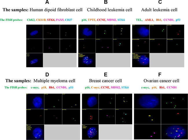 qmFISH was tested on samples of normal diploid cells (A) as well as cell samples from childhood leukemia (B), adult leukemia (C), multiple myeloma (D), breast cancer (E) and ovarian cancer (F).