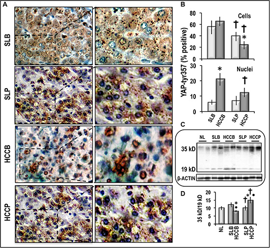 pYAP-tys357 expression and Caspase 3 cleavage in human HCC and corresponding surrounding liver.