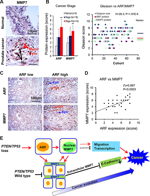 MMP7 correlates with ARF in human prostate cancer specimens.