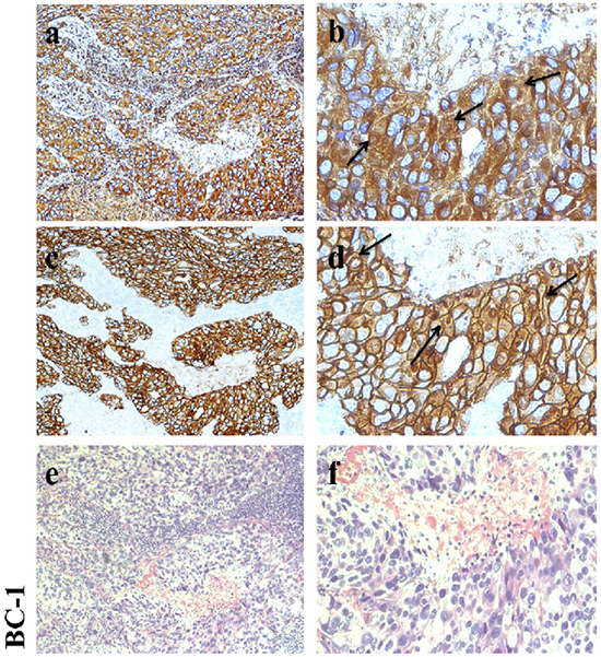Immunohistochemical analysis of CD147 and HER2 expression in HER2-positive breast cancer.