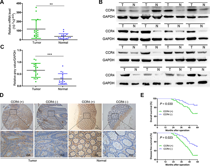 Expression of CCR4 and its clinical significance in CRC patients.