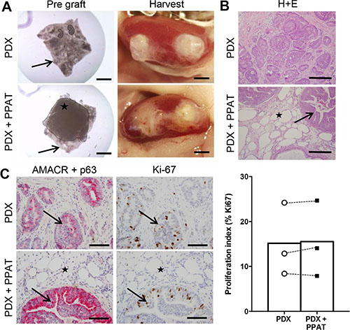 Periprostatic adipose tissue does not promote tumorigenesis in patient-derived xenograft tissues.