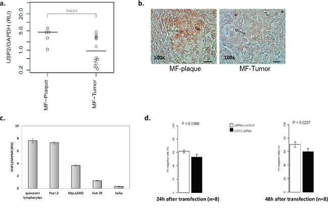 USP2 is expressed in CTCL with a stage-dependant manner.