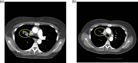 Computed tomography (CT) scans of a NSCLC patient (case #5, Table 2) with two sensitive