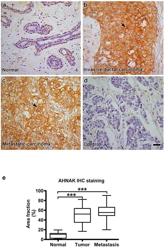 AHNAK is highly expressed in human mammary carcinoma cells in vivo.