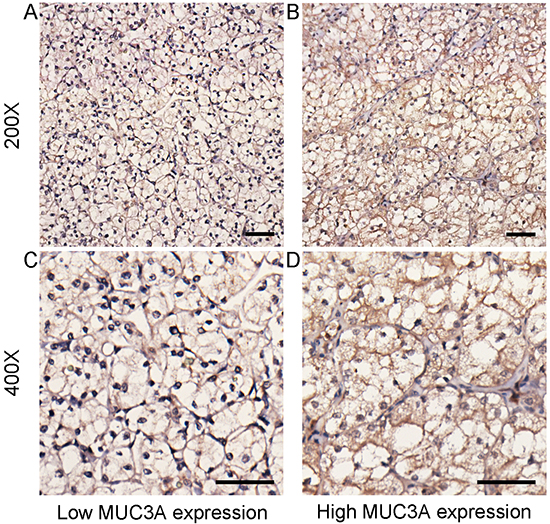 MUC3A expression in localized clear-cell renal cell carcinoma (ccRCC) tissues.