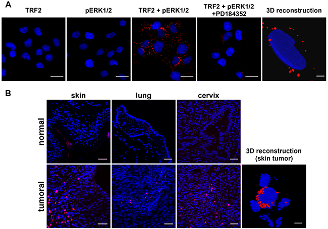 TRF2 and pERK1/2 interact in the cytoplasm of a melanoma cell line and human cancer samples.