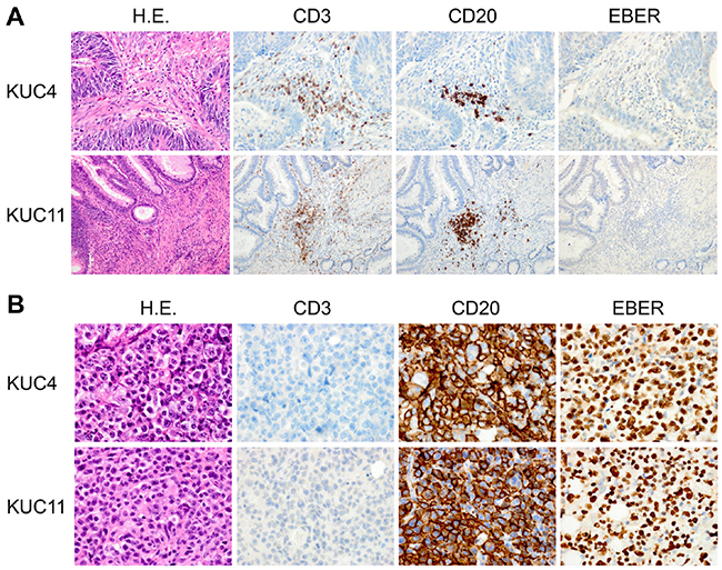 Establishment of the DLBCL PDXs from human CRC specimens.