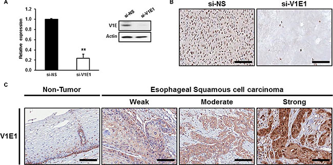Immunohistochemical analysis of V-ATPase V1E1 in non-tumor esophageal and esophageal squamous cell carcinoma tissues.