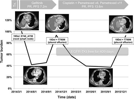 Case presentation demonstrated the long-term existence of T790M after an objective response to chemotherapy and a long EGFR-TKI-free period (PR, partial response; PFS, progression-free survival).