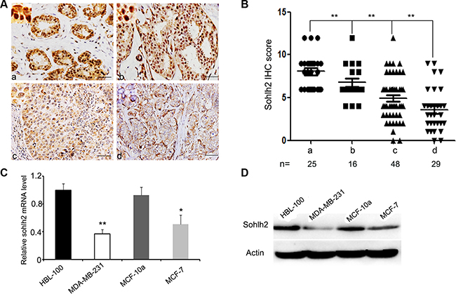 Reduced expression of sohlh2 is correlated with the metastasis of breast cancer.