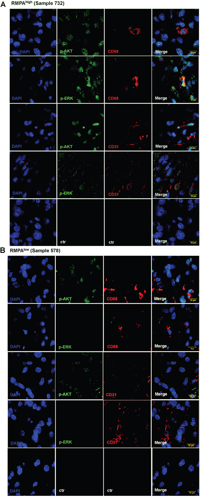 Activation of RTK signaling in vessel endothelial cells and TAMs in RMPAhigh gliomas.