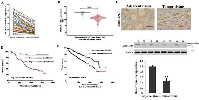 High expression of ARHGAP24 indicates better survival of renal cancer.