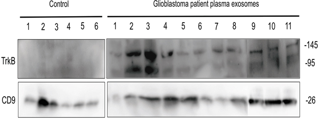 TrkB expression in exososmes from GBM patients.