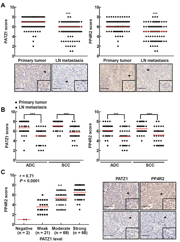 Lung cancers at the primary sites have more PP4R2 and PATZ1 than those at the metastatic sites.