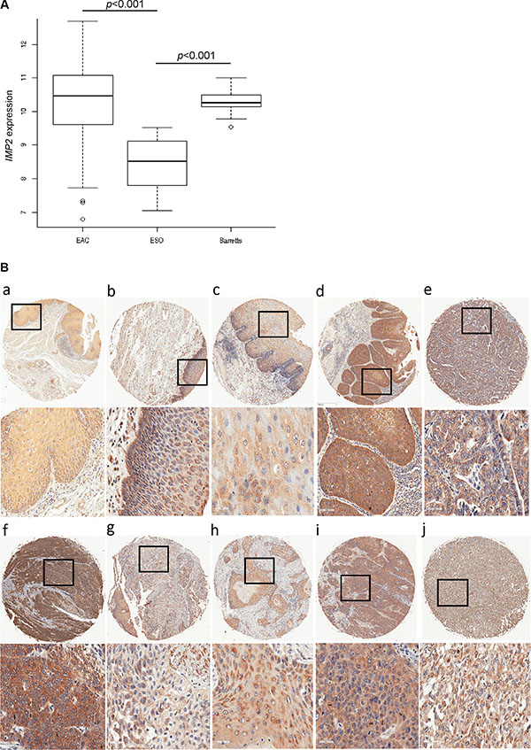 IMP2 overexpression in esophageal hyperplasia and cancer.