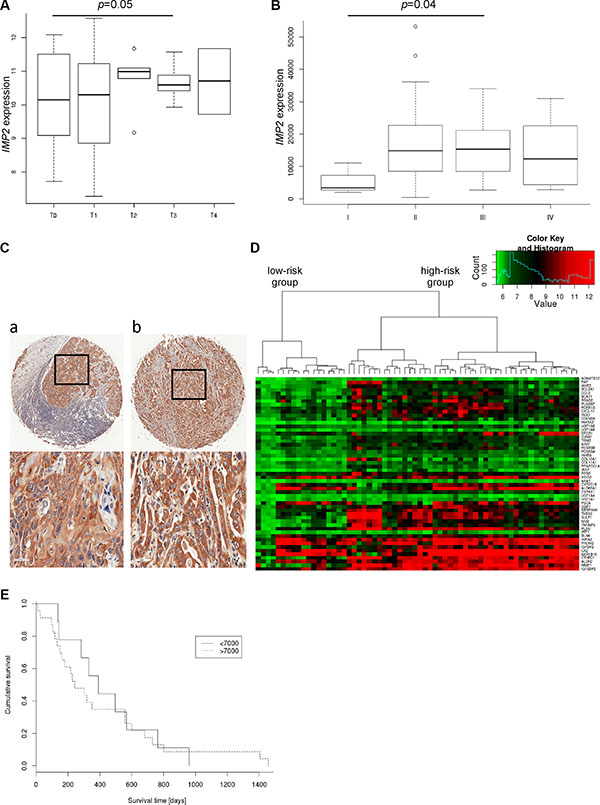 IMP2 expression increases with tumor size, metastasis and poor prognosis.