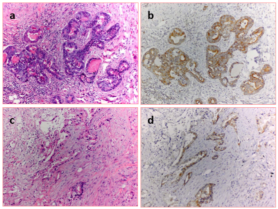 Figure1: Expression of LH-RH receptors in human pancreatic cancer.