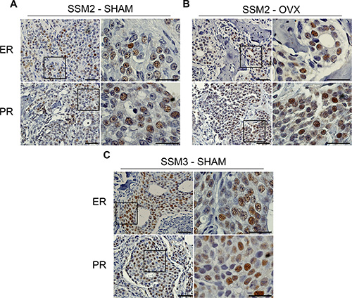 Bone residing SSM2 and SSM3 cells express ER and PR.