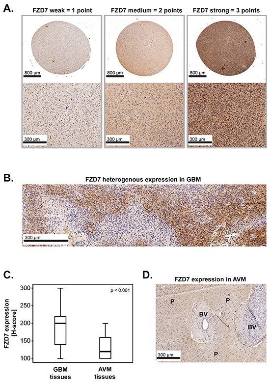 FZD7 in primary GBM: expression and scoring system.