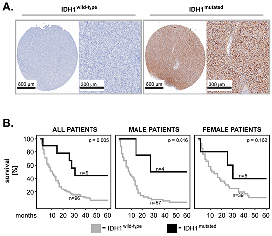 IDH1 mutation in primary GBM: impact on patients&#x2019; overall survival and sex differences.