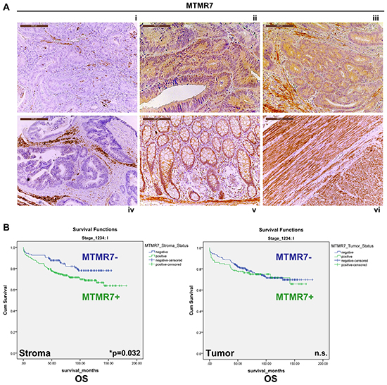 Expression and prognostic significance of MTMR7 in CRC patients.