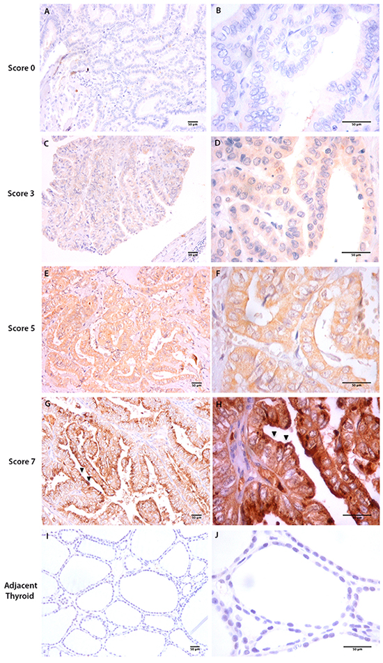 Total OPN (tOPN) IHC staining in cPTC samples.