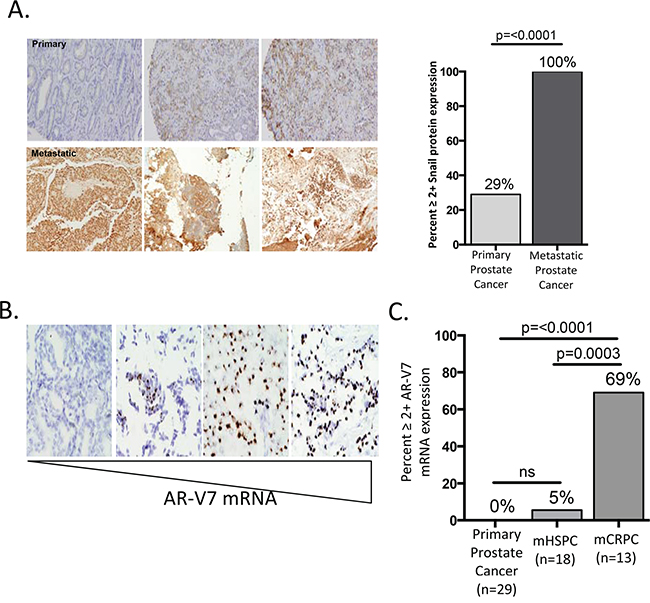 Snail expression is enriched in metastatic biopsies.