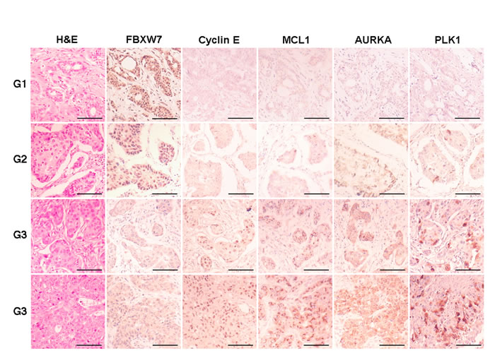 Immunohistochemical expression of FBXW7 and substrates in breast carcinomas.