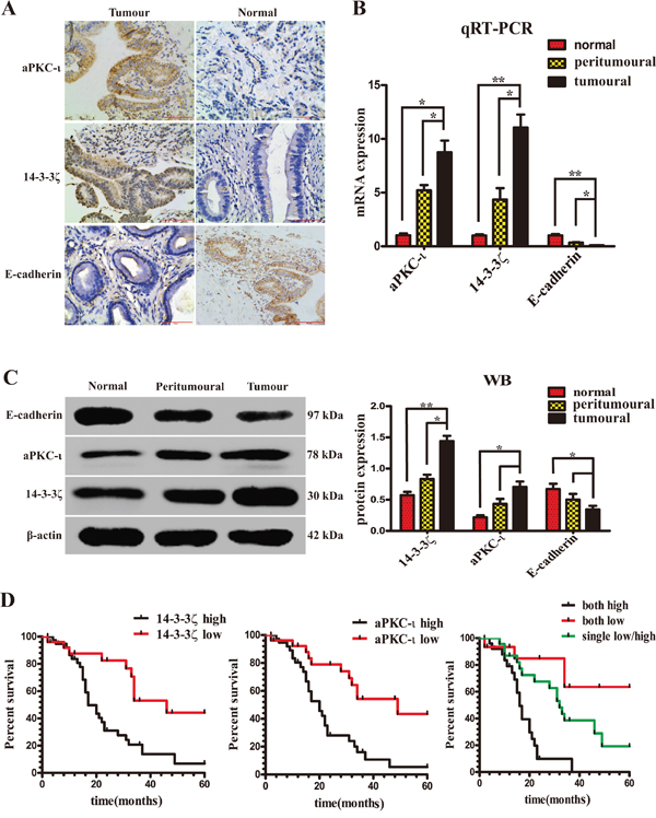 Expression of 14-3-3&#x03B6;, aPKC-&#x03B9; and E-cadherin in patients with CCA. The expression of 14-3-3&#x03B6; and aPKC-&#x03B9; correlates with the prognosis of patients.