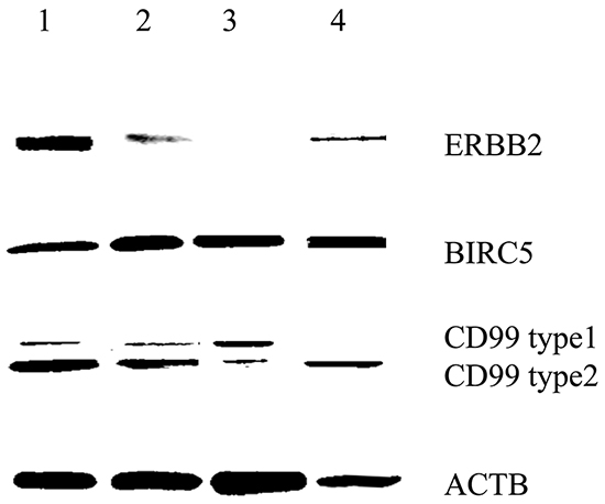 BIRC5, CD99 and ERBB2 expression of human glioblastoma cell lines and primary glioblastoma cells by Western blot.