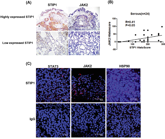 STIP1 and JAK2 are co-expressed in ovarian cancer tissues.