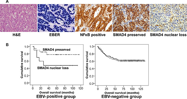 Different clinical implication of SMAD4 expression in EBV-positive and EBV-negative stomach cancer patients.