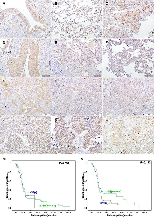 Immunohistochemical staining in lung cancer and adjacent normal lung tissues.