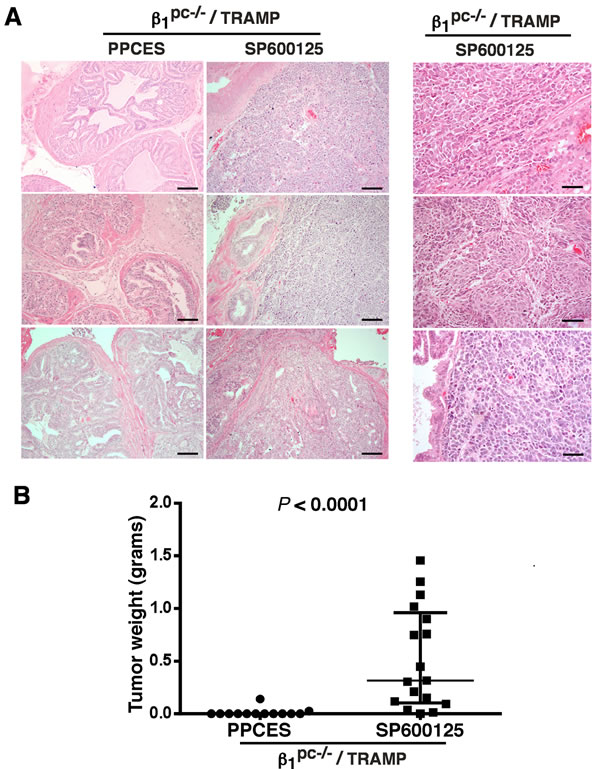 JNK inhibition counteracts the effect of irradiation and supports aggressive prostate growth in &#x3b2;1