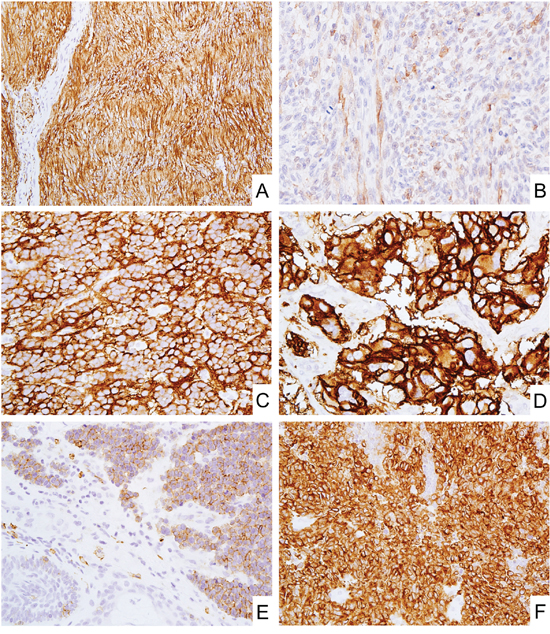CD171 expression in neural, neuroectodermal and neuroendocrine tumors.