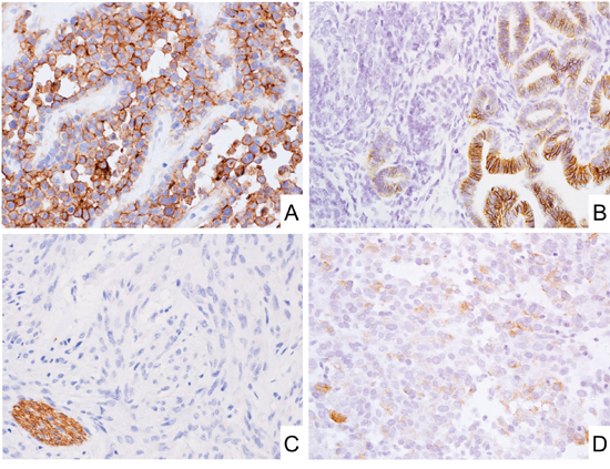 CD171 expression in mesenchymal tumors.