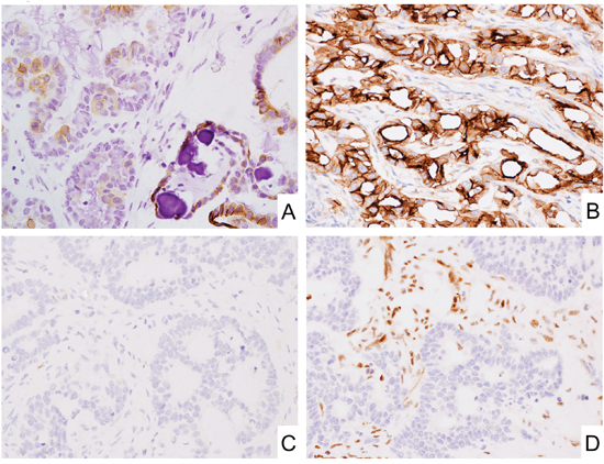 CD171 expression in epithelial tumors.