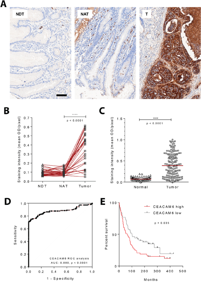 CEACAM6 protein expression by quantitative immunohistochemistry in gastric cancers.