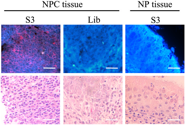 Fluorescence imaging of cancer cells in NPC tissues stained with QD635-labeled S3 aptamer or library.