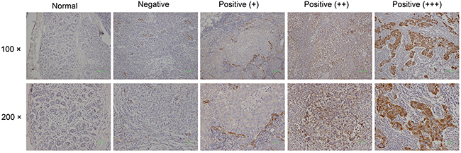 Immunohistological SPARC expression in tumors and normal breast tissue.