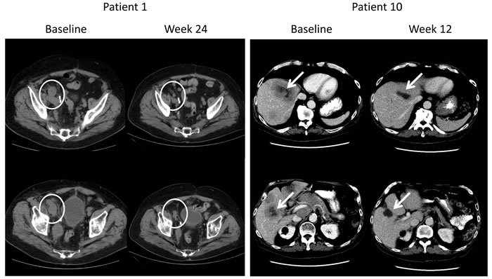 Radiographic Responses in Patients With Measurable Disease.