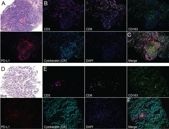 Multi-spectral imaging reveals leukocyte infiltration in biopsies from men with metastatic castrate-resistant prostate cancer (mCRPC).