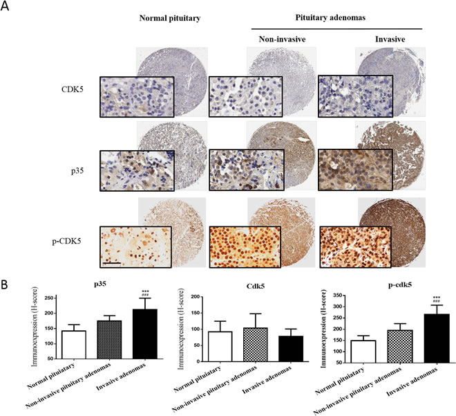 p35 protein and p-CDK5 levels are highly expressed in invasive pituitary adenoma tissue.
