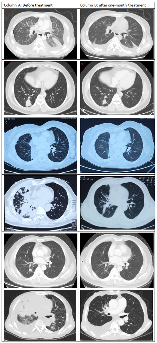 Comparisons of initial computed tomography (CT) images of the thorax with CT images at 1 month after initiation of crizotinib treatment.