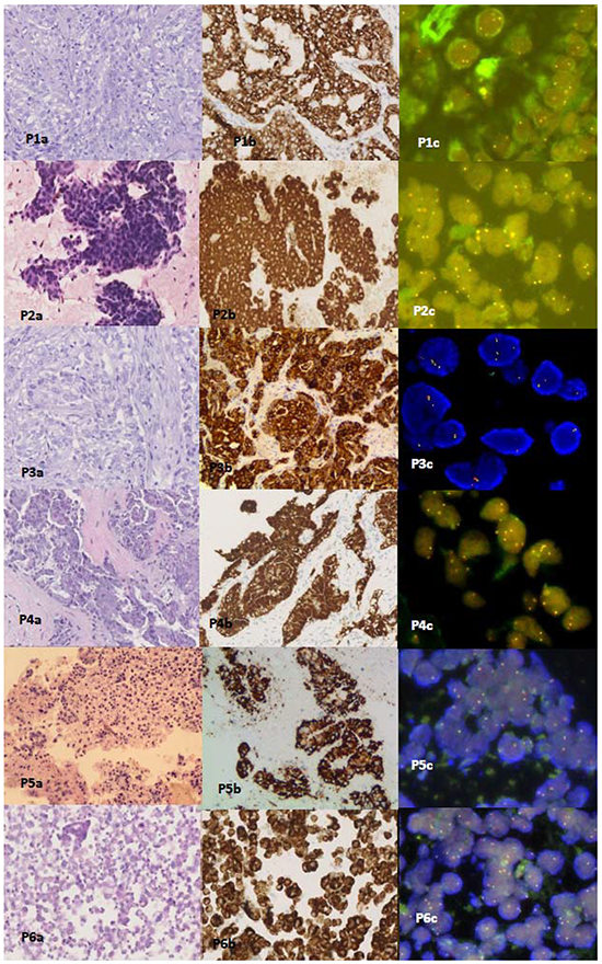 Hematoxylin and eosin (H&E) staining, Ventana IHC(D5F3) staining, and FISH staining slides from Patients 1-6.