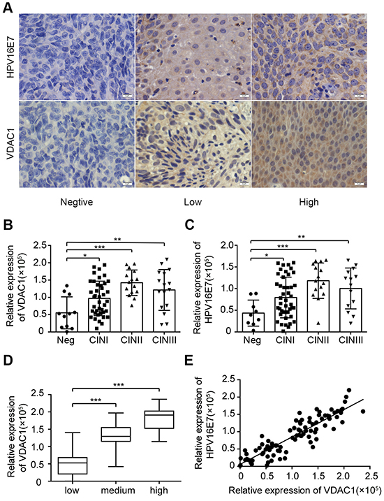 VDAC1 / HPV16 E7 levels correlated with clinicopathologic features and each other in CIN.
